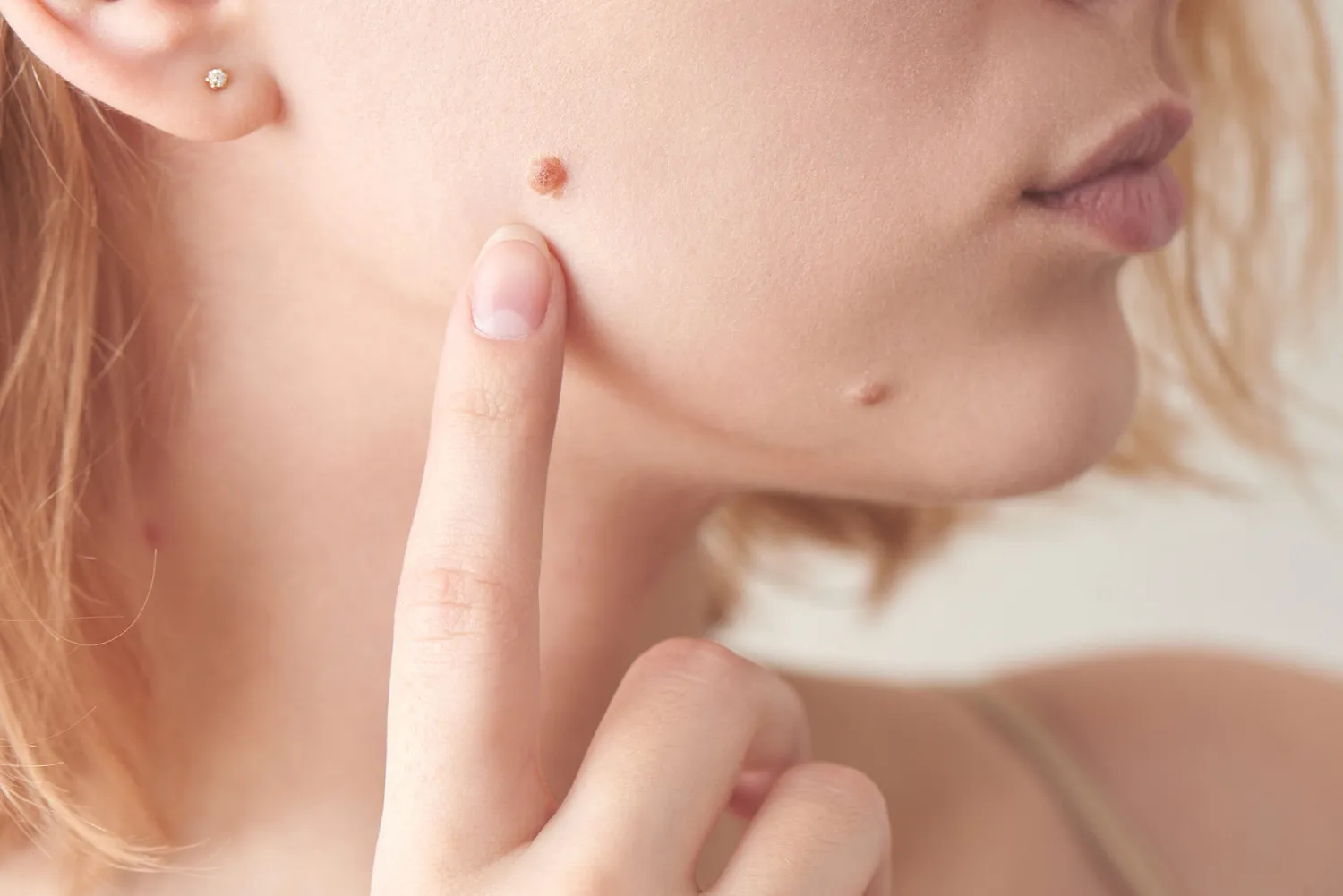 Freezing vs. Snipping: Which Skin Tag Removal Method Is Best?